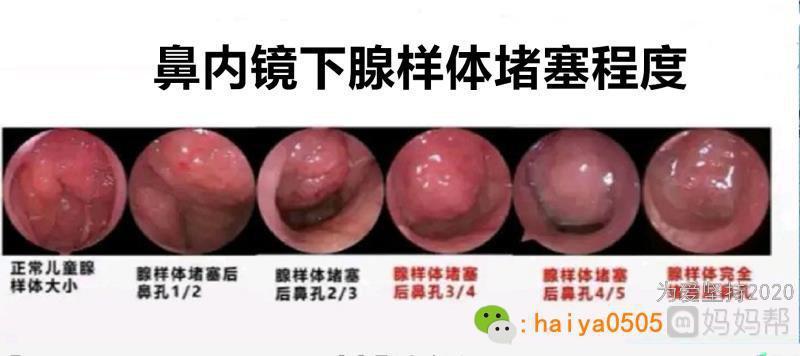 腺样体肥大鼻塞不要忽视鼻甲肥大哦