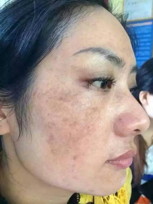 黄褐斑!脸上有斑,就感觉脸脏脏的怎么洗都洗不干净!拍照还得用美拍!