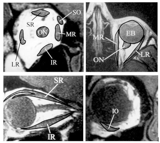 眼外肌在mri的定位 on=视神经;so=上斜肌;mr=内直肌;ir =下直肌