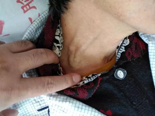 脖子上的血管鼓出来是怎么回事?