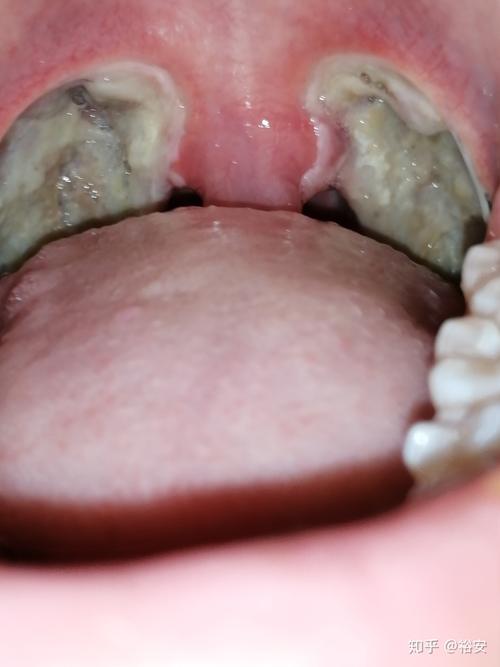 扁桃体摘除手术记录