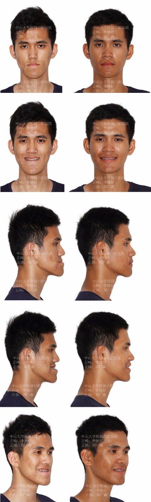 骨性"地包天"的治疗策略(案例不断更新)