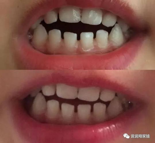 会引起胀气和吐奶?被误会的安慰奶嘴,到底