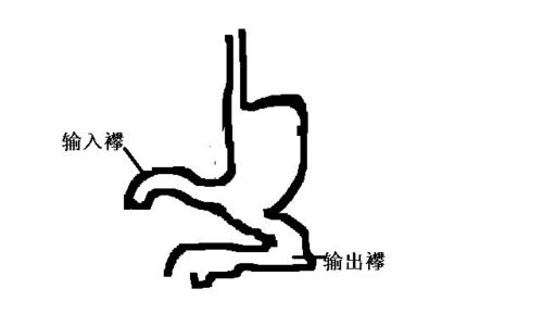 胃十二指肠溃疡手术中 输入襻 输出襻 是什么意思 请