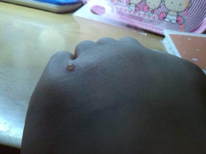 孩子得水痘,家长千万不要大意!
