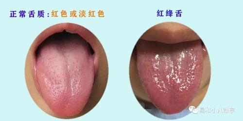 舌质淡红色,红色为正常  红绛舌有内热 淡白舌气血不足 青紫色舌质有
