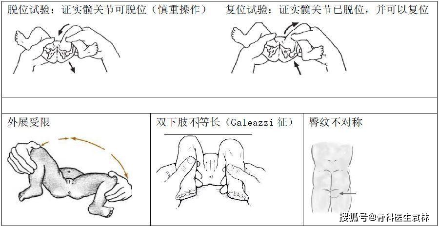 髋关节发育不良有什么症状_髋关节发育不良的症状是什么