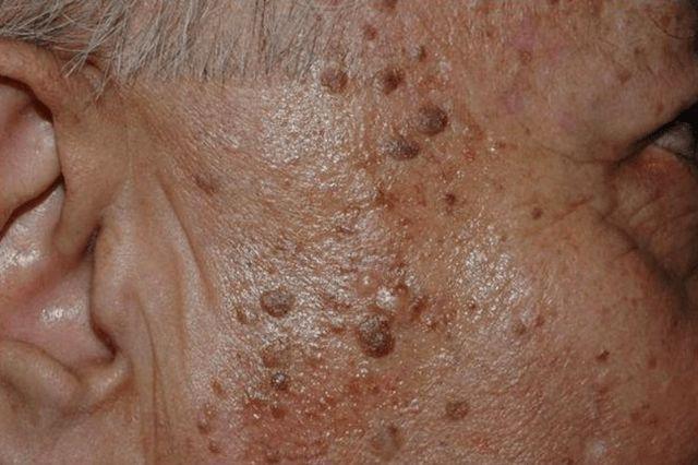 有些人的老年斑密密麻麻有些人却几乎没有看完了解了