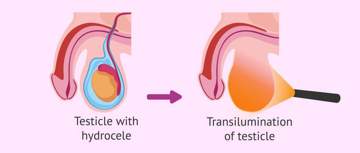 睾丸的半透明化