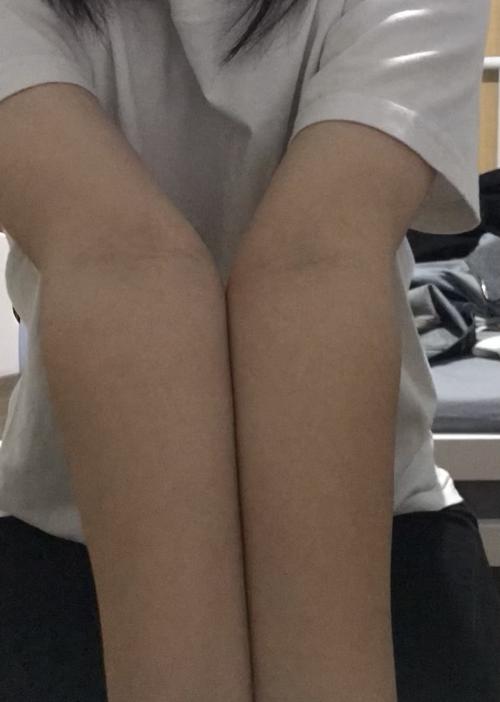 uus 请问这是肘外翻吗