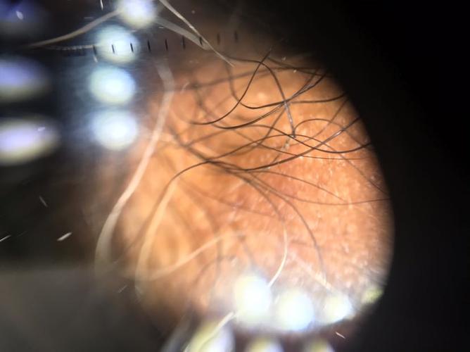 一位阴囊瘙痒引起的瘙痒……虱子