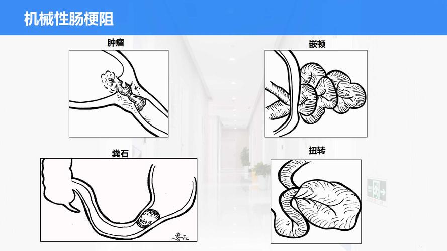 4 常见机械性肠梗阻的临床表现 所属课程:《外科护理实训指导及习题集