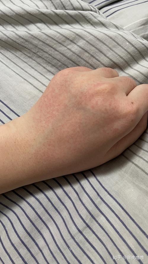 手背上突然起了一片小红点