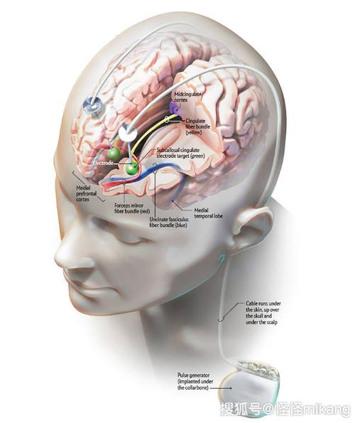 成瘾:大脑中植入电极治疗精神病靠谱吗?