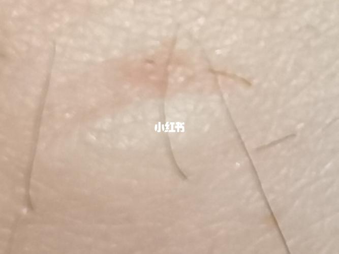 一直吃小龙虾的人,今天突然一下过敏了_过敏_小龙虾_医疗健康_医疗