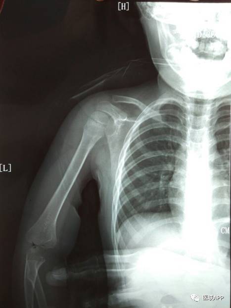 小儿锁骨青枝骨折一例