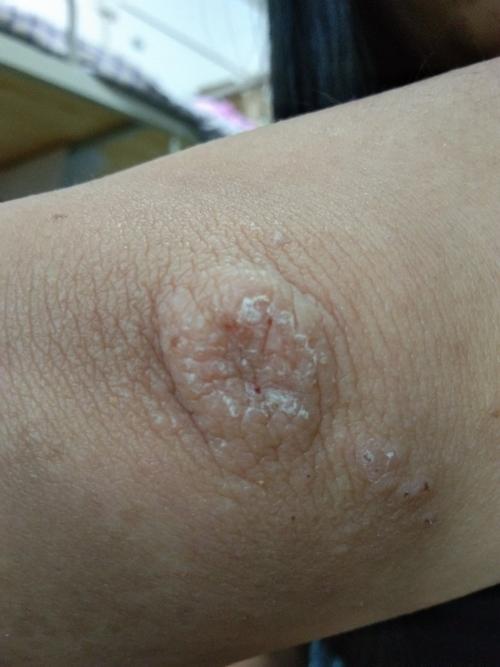 工作长期住胳膊肘,长了个大包,又红又痒又肿怎么办