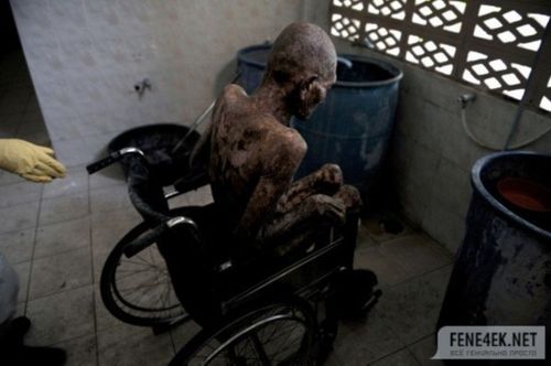 艾滋病多久身上会烂掉