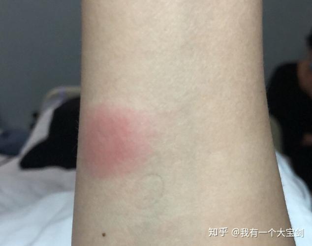 我的抗结核日记