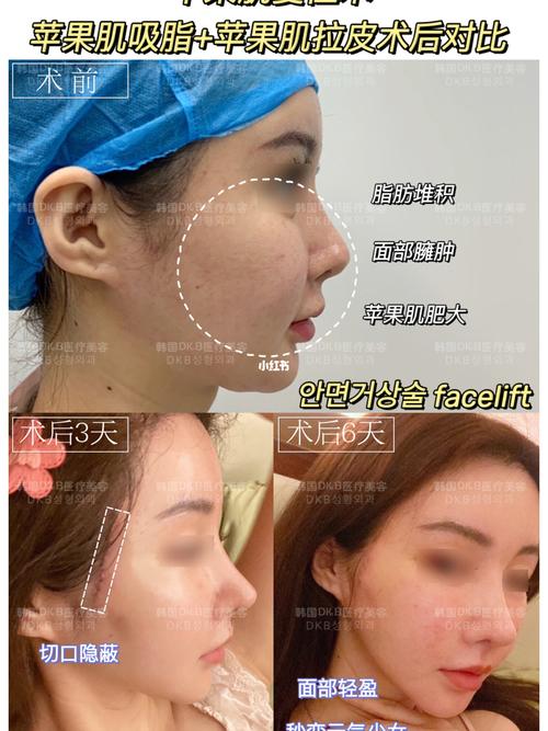 苹果肌_苹果肌_迷你_吸脂_拉皮_摄影_美妆_医美整形