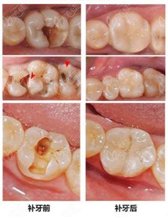 北京的儿童医院补牙一般多少钱?这个附带医院介绍的价格表属实不错!