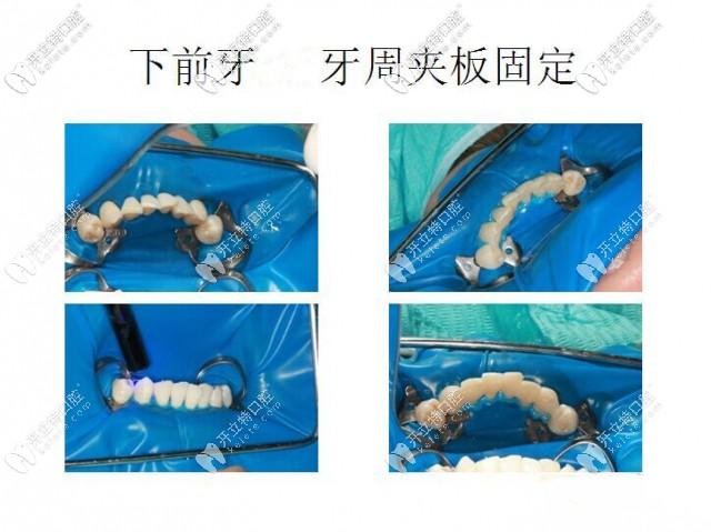 牙齿用手晃有点松动的你,这松牙固定术简直是"救星"