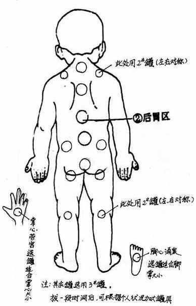 我用拔罐治好了女儿的湿疹--附开罐图