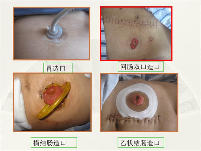 造口病人居家护理.ppt