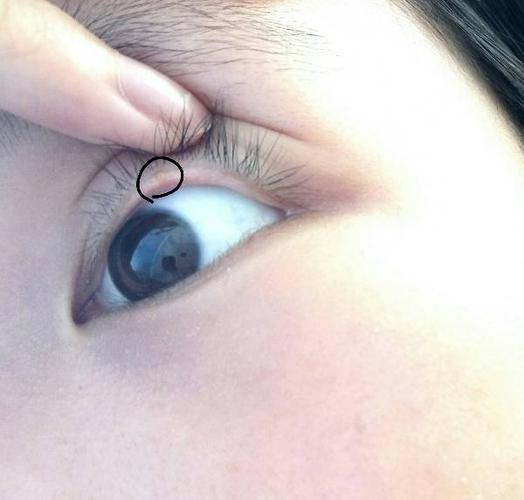今早洗脸发现的在睫毛根部不痛不痒很小一颗差不多笔尖大小(ps:图片