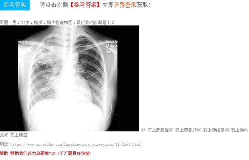 男,27岁,胸痛,胸片检查如图,最可能的诊断是()