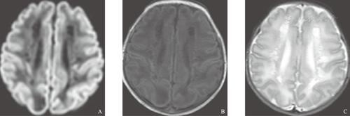 脑室周围白质软化早产儿出生早期mri表现及其演变