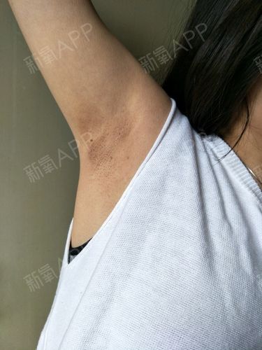 16岁男生长腋毛已经算发育到什么阶段了?身高170cm,还能长多高?