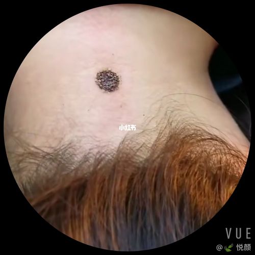 一次性去除黑痣,肉痣_美妆_医美_整容_美妆_医美整形
