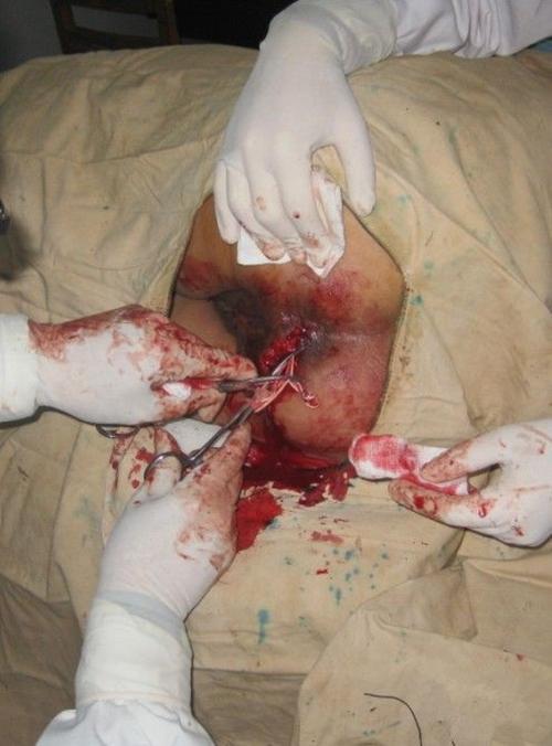 女性前位肛瘘的图片