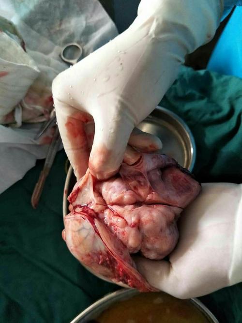 睾丸肿瘤切除术