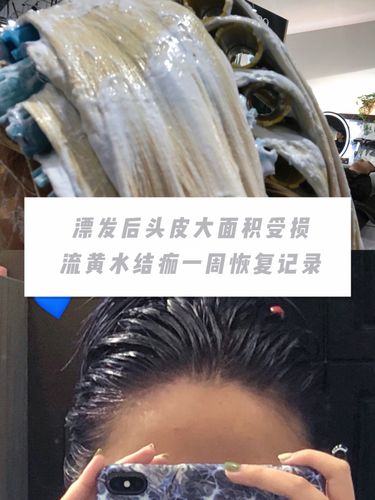 喜欢漂染的姐妹一定遇到过同样的情况,头皮流水开始结黄色的痂,头发