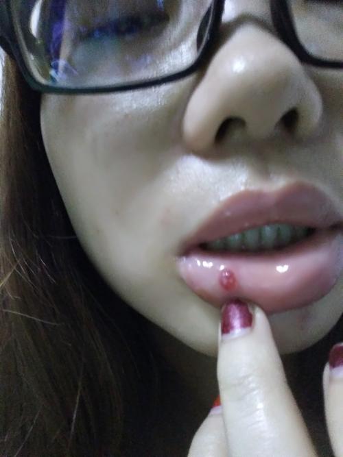 口腔粘液腺囊肿