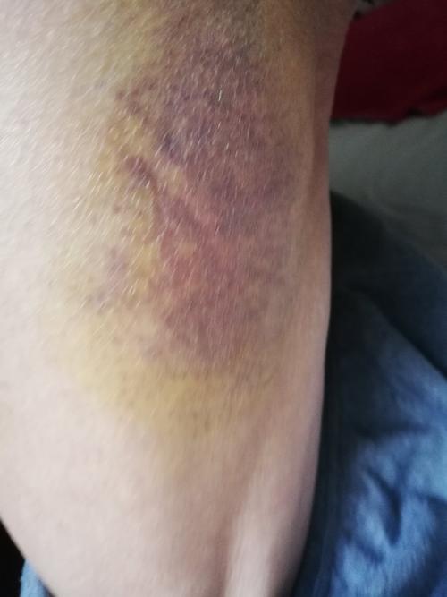 左大腿外侧瘀血