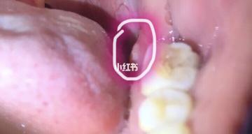 牙槽骨骨突