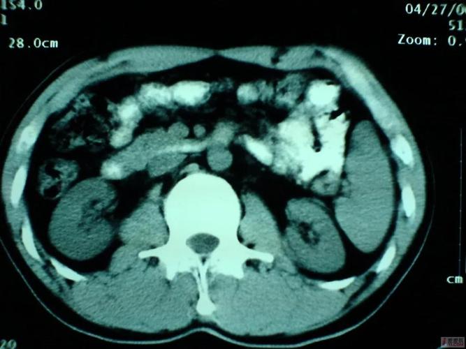 【健康科普】副脾,一个你意想不到的备胎