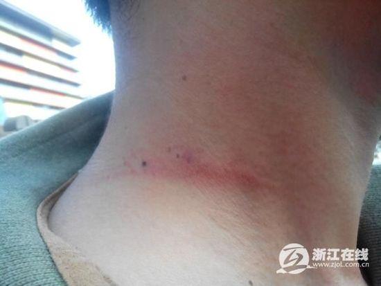 业主维权被打 脖子有掐红的痕迹