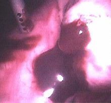 宫颈囊肿中医治疗特效根治方