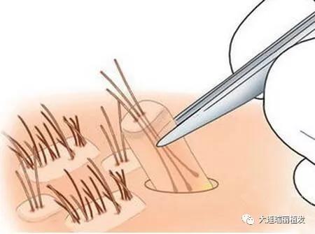 揭秘植发全过程!