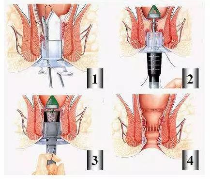 痔疮手术方式简述