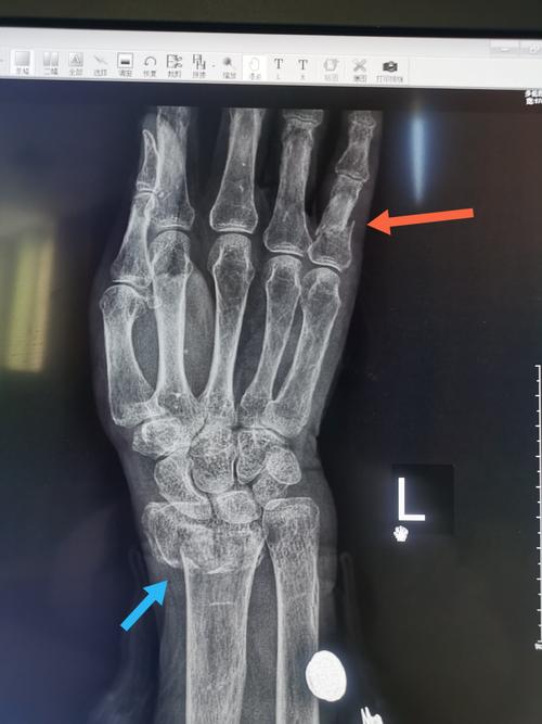 一例桡骨骨折,可以看到合并近端指骨骨折
