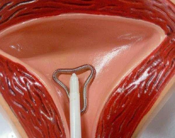 想上环避孕的女人需提前了解这3件事才能有效规避风险