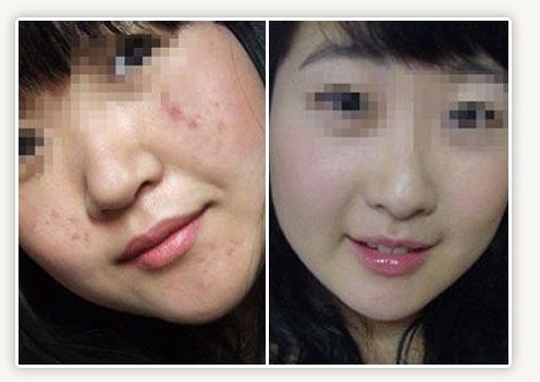 可到了19岁那年,一切都改变了,曾经的美少女变成了一个满脸是痘的痘痘