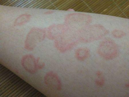 三个月前,食指和中指上长个两个这样的包,很痒,外面一圈红的.