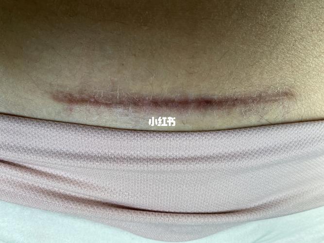 剖腹产疤痕增生-祛疤针前后对比(有图慎入)_疤痕_祛疤