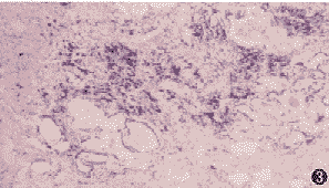 普通型间质性肺炎的病理诊断